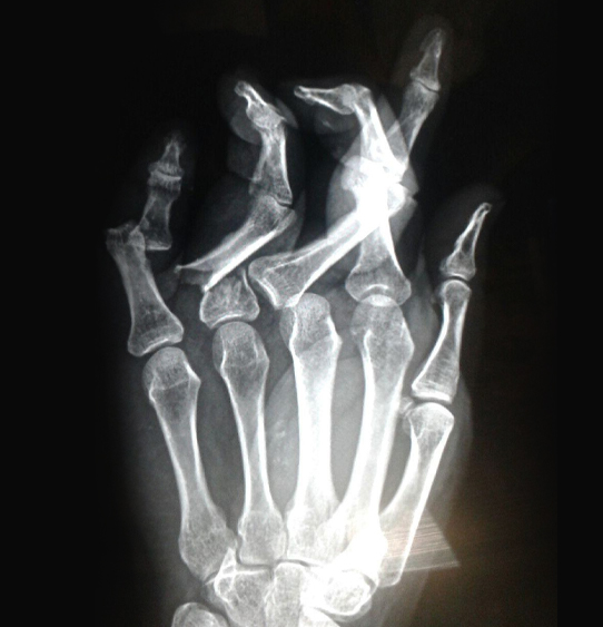 mj hand xray